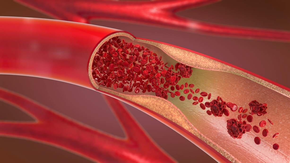 Blood vessel cross-section with red blood cells and a large blood clot causing partial blockage., longevity-focused heart health